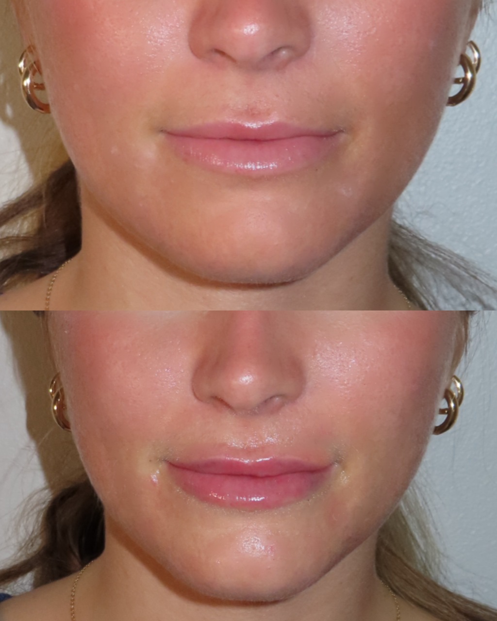 Lip Filler Before & After