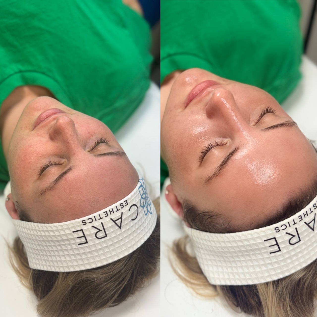 Before and after custom facial treatment at Care Esthetics Delaware
