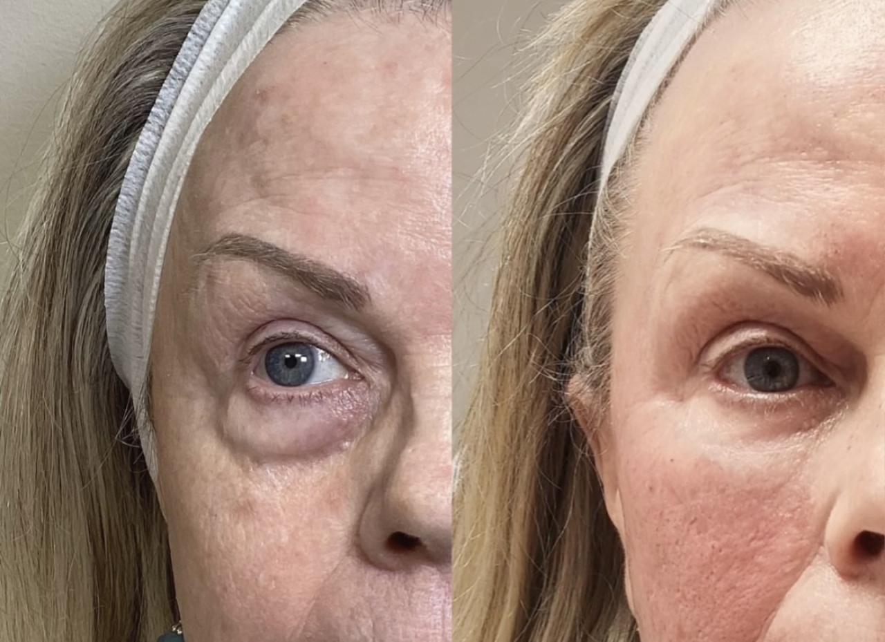 Before and after under eye bio filler at Care Esthetics Delaware