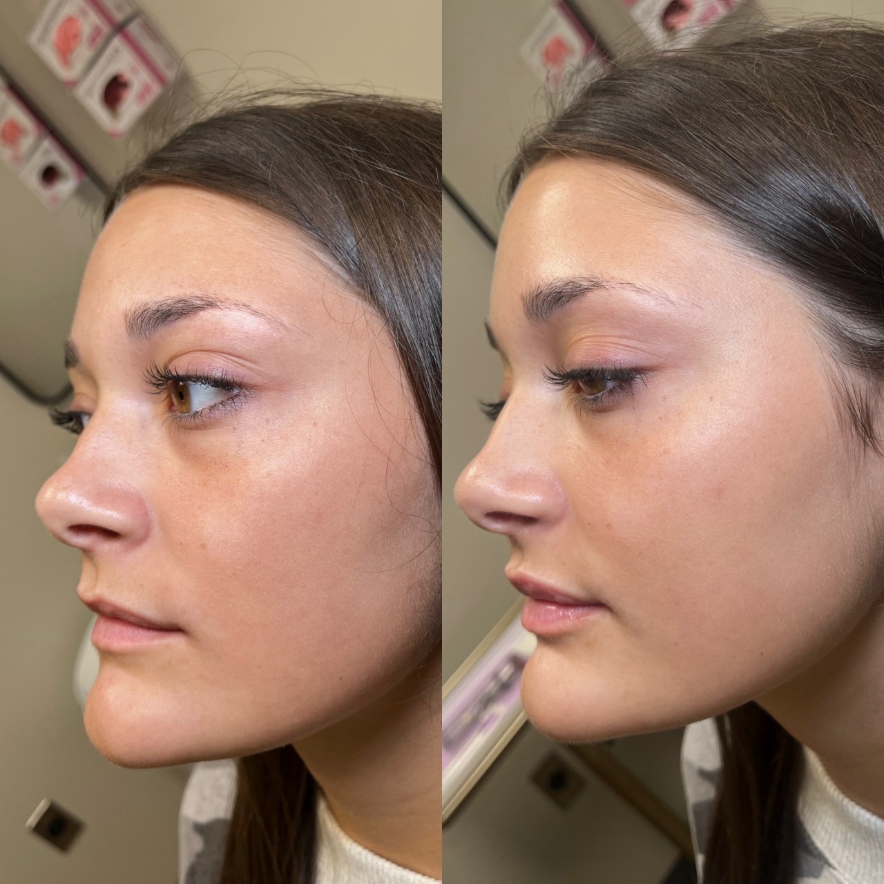 Before and after lip filler and neurotoxin at Care Esthetics Delaware