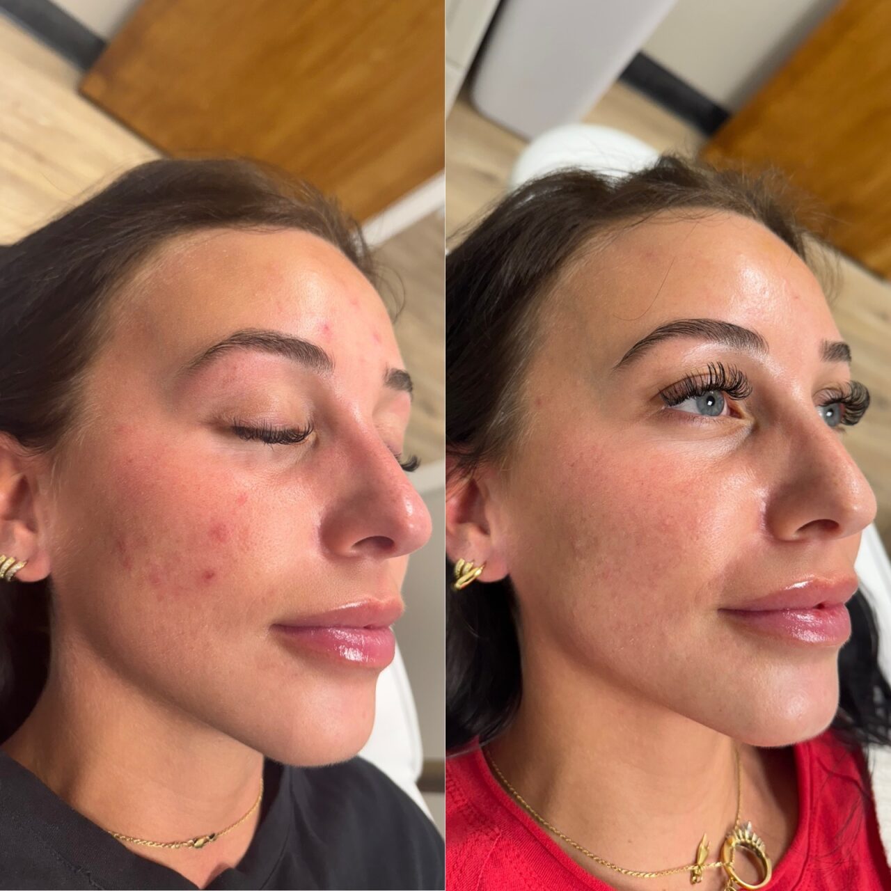 Before and after chemical peel at Care Esthetics Delaware