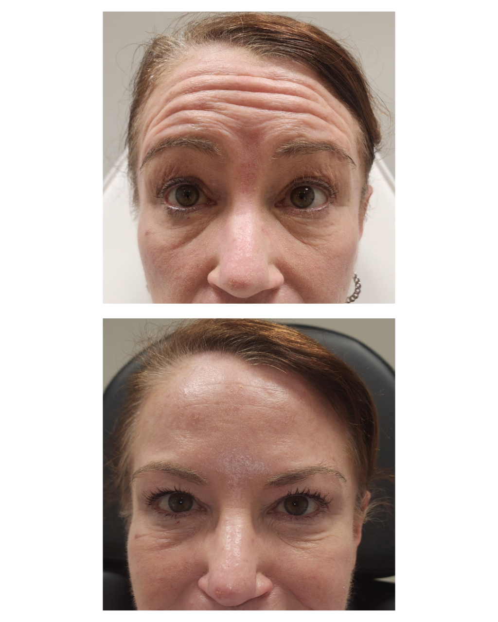 Before and after neurotoxin for forehead lines at Care Esthetics Delaware