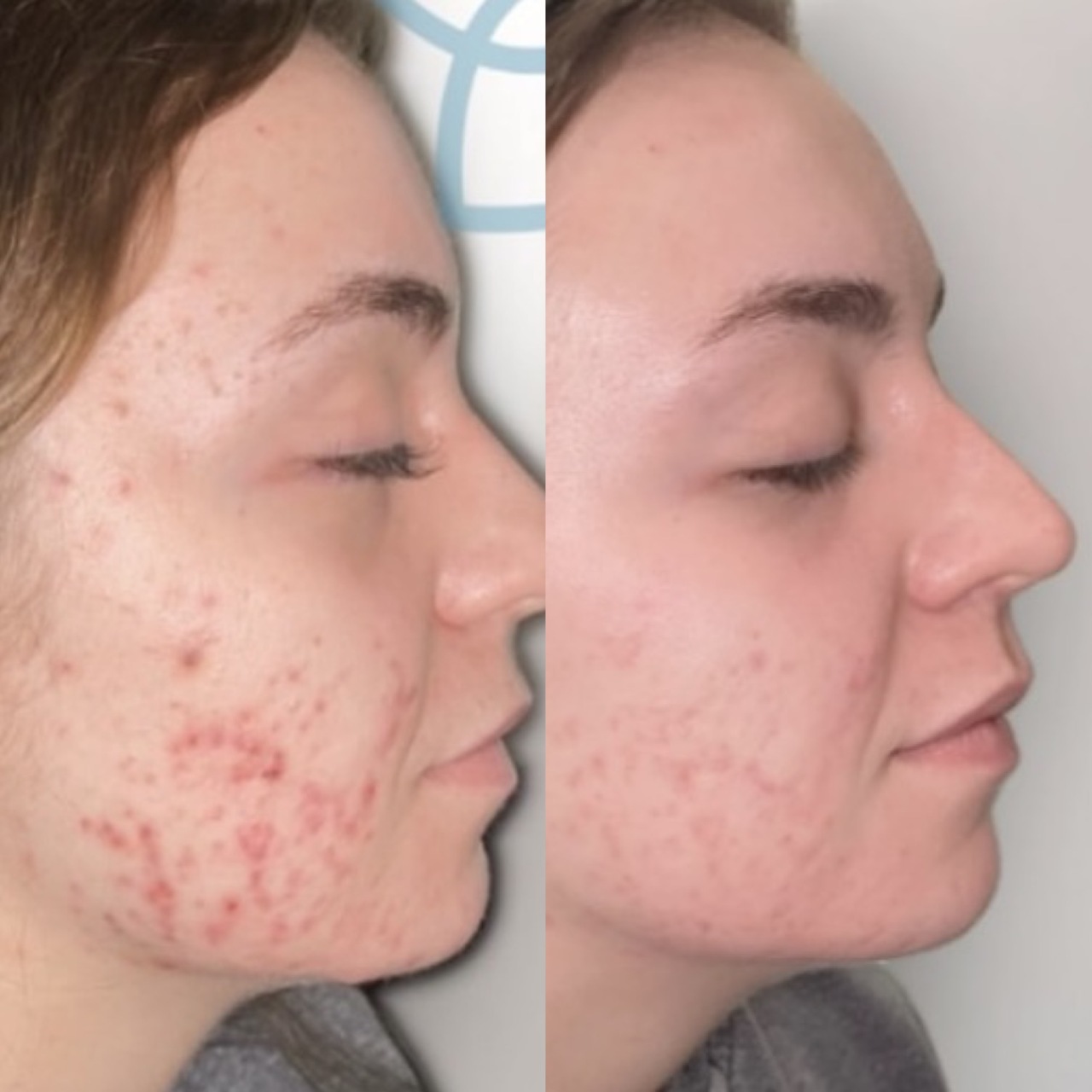 Before and after PRF microneedling for acne and skin texture at Care Esthetics Delaware