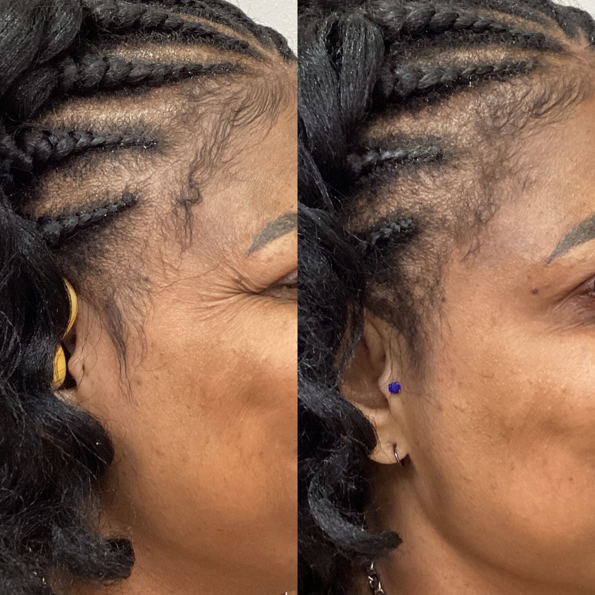 Before and after neurotoxin for crow's feet at Care Esthetics Delaware