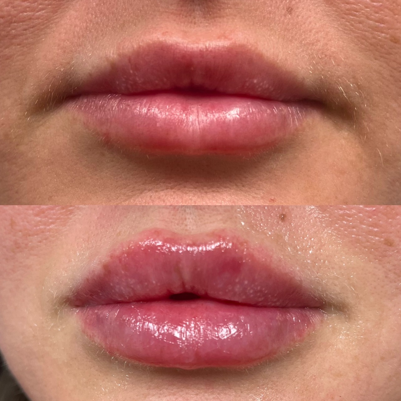 Lip Filler Before & After