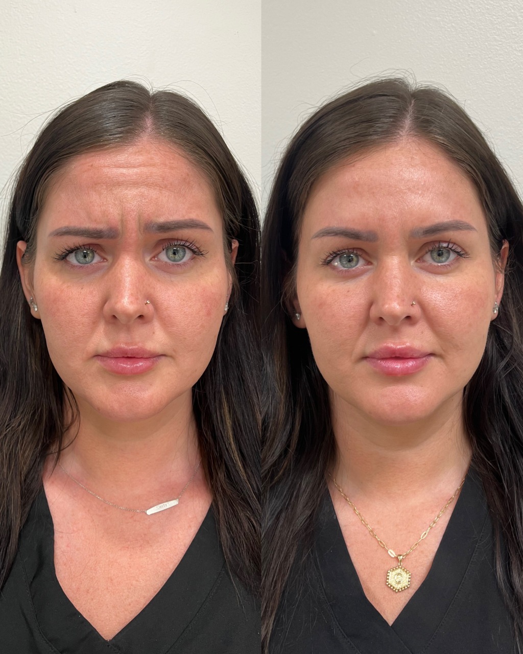 Before and after neurotoxin treatment for forehead lines at Care Esthetics Delaware