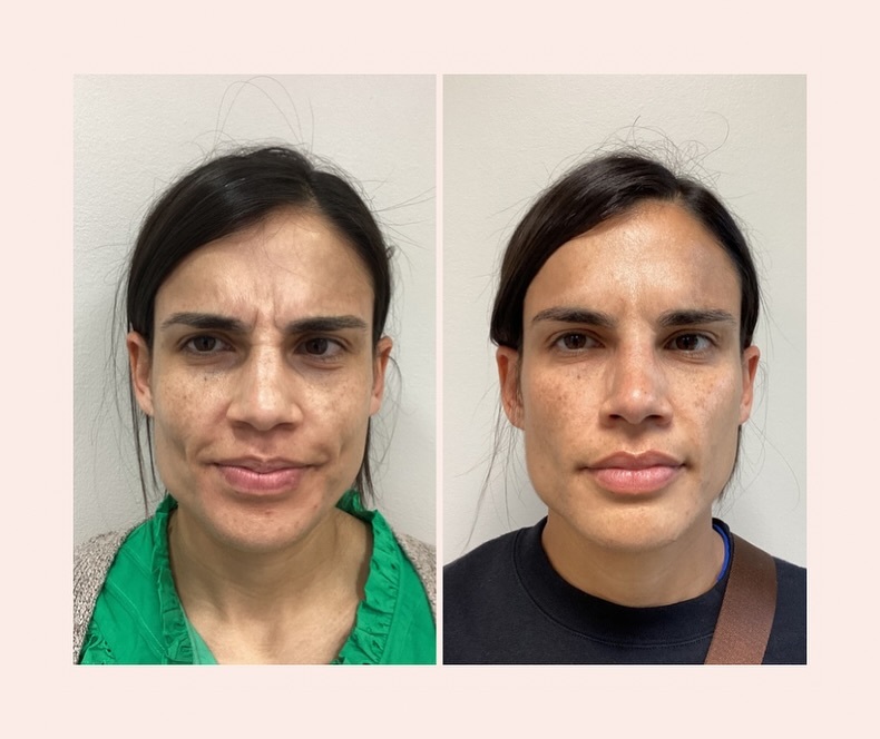 Before and after neurotoxin for 11 lines at Care Esthetics Delaware