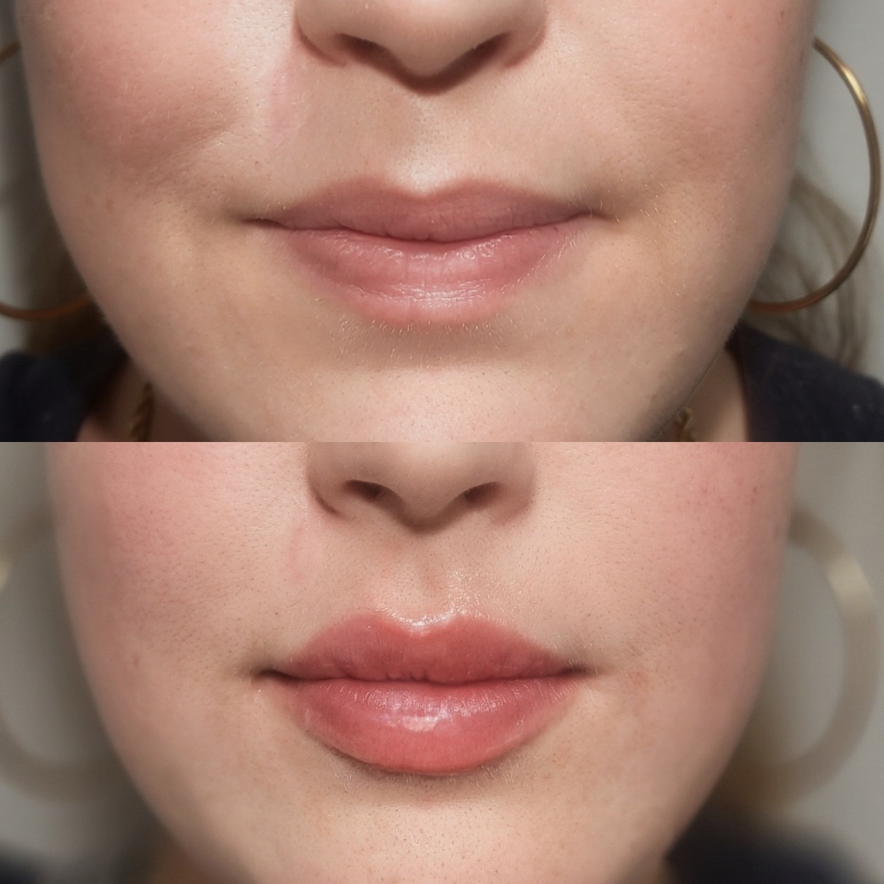 Lip Filler Before & After