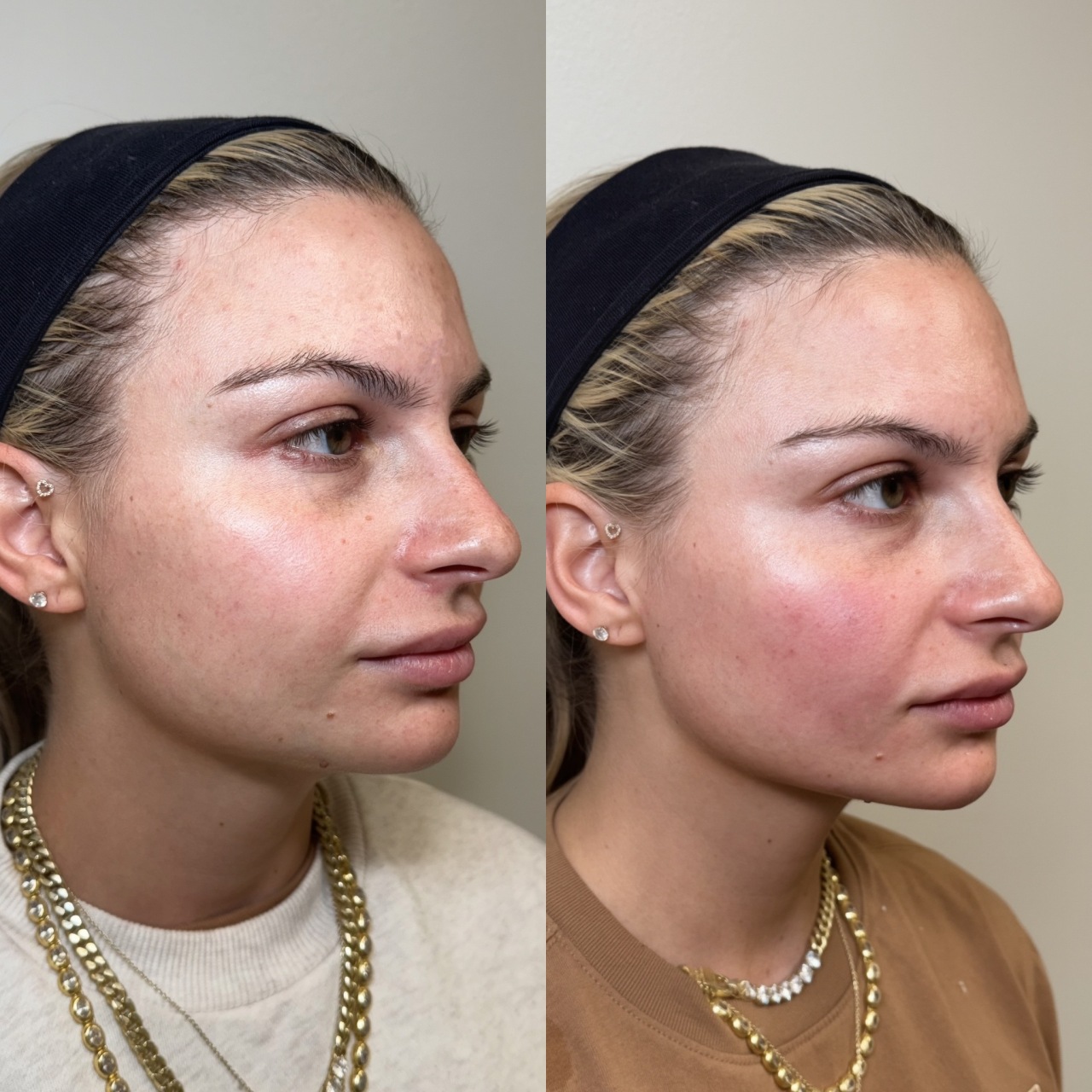 Before and after facial filler at Care Esthetics Delaware