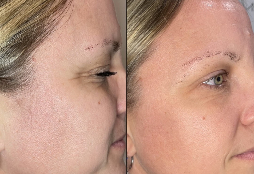 Before and after PRF microneedling skin rejuvenation at Care Esthetics Delaware