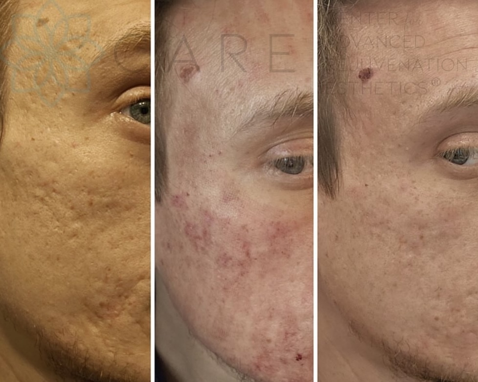 Before and after PRF microneedling for acne scarring at Care Esthetics Delaware